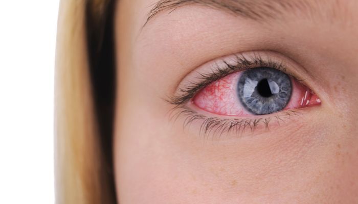 Conjunctivitis and Red Eyes